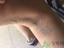 40歲女性小腿靜脈曲張?jiān)趺崔k？