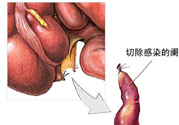 闌尾手術會影響結腸嗎？闌尾手術術后要注意什么？