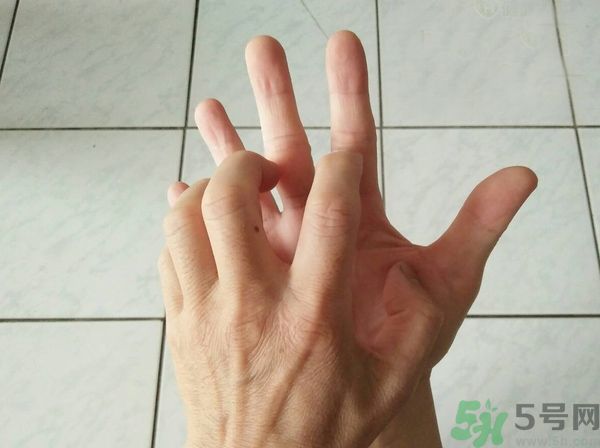 手上起水泡是什么原因？怎樣預防手上起水泡？