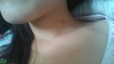 種草莓吻痕是什么意思？吻痕是怎么弄出來的？