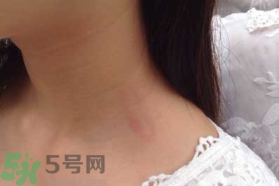 種草莓吻痕是什么意思？吻痕是怎么弄出來的？