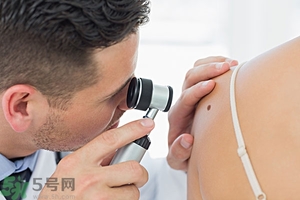 臉上長(zhǎng)痣是什么原因？臉上為什么會(huì)長(zhǎng)痣？