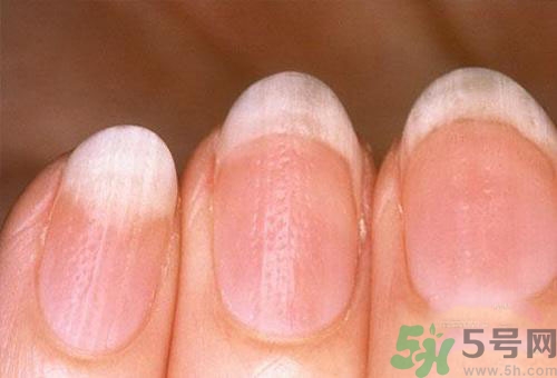 指甲發(fā)白是怎么回事？指甲發(fā)白代表什么？