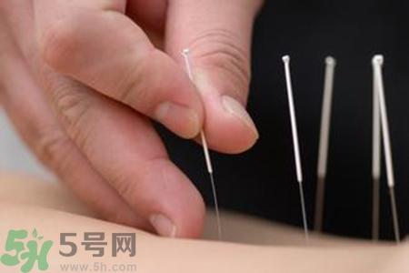 大暑可以針灸嗎？大暑針灸好不好？