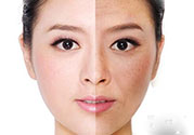 激光美白有用嗎？激光美白可以維持多久？