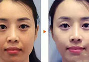 激光美白多少錢？激光美白價格