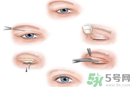 割雙眼皮分哪幾種？割雙眼皮需要多少錢？