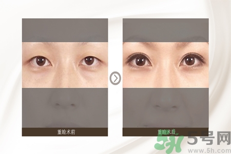 割雙眼皮分哪幾種？割雙眼皮需要多少錢？