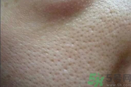 皮膚毛孔粗大原因有哪些？如何預(yù)防皮膚毛孔粗大？