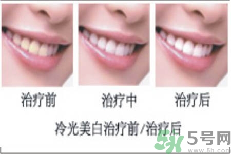 冷光美白牙齒是什么？冷光美白牙齒的好處有哪些？