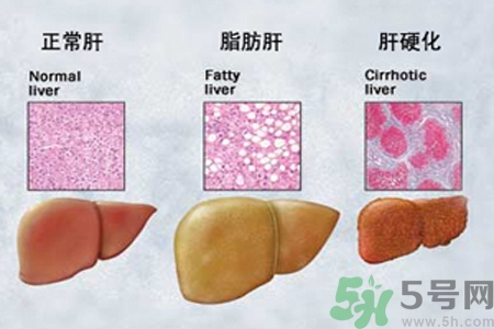 妊娠急性脂肪肝是什么？妊娠急性脂肪肝的治療方法？