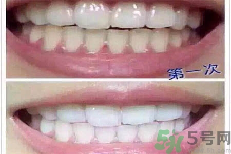 冷光美白牙齒的價(jià)格是多少？做冷光美白牙齒需要多少錢？
