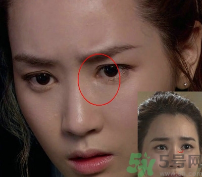 開眼角多少錢？開眼角有什么危害？