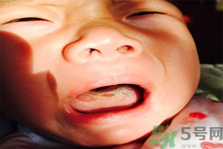舌頭燙傷后該怎么辦呢？舌頭燙傷后應(yīng)該注意吃什么？?