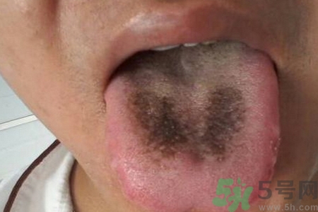 舌頭發(fā)黑怎么回事？舌頭發(fā)黑怎么辦？