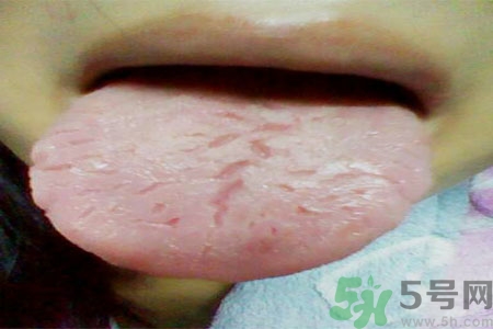 舌頭上有裂紋是怎么辦？舌頭上有裂紋是什么原因？