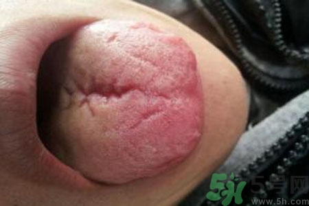 舌頭上有裂紋是怎么辦？舌頭上有裂紋是什么原因？