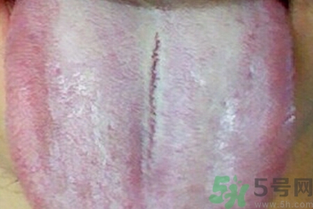 舌頭發(fā)白是什么原因？舌苔發(fā)白是怎么辦？