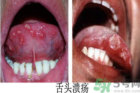 舌頭潰瘍怎么辦？舌頭潰瘍的原因？