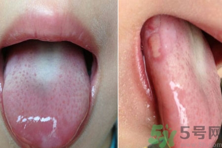 舌頭潰瘍怎么辦？舌頭潰瘍的原因？