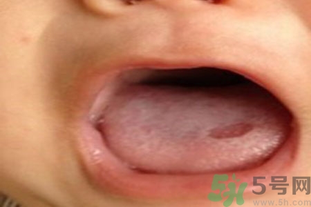 舌頭潰瘍怎么辦？舌頭潰瘍的原因？