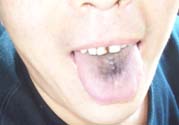 舌頭發(fā)黑怎么回事？舌頭發(fā)黑怎么辦？