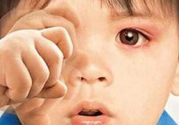 寶寶得了紅眼病怎么辦？寶寶得了紅眼病怎么治？