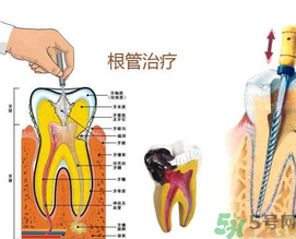 什么是根管治療？為什么牙齒疼要做根管治療？