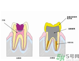 什么是根管治療？為什么牙齒疼要做根管治療？
