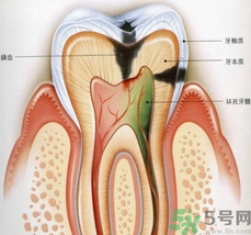 什么是根管治療？為什么牙齒疼要做根管治療？