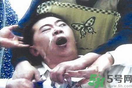 癲癇的典型癥狀有哪些？癲癇是什么？