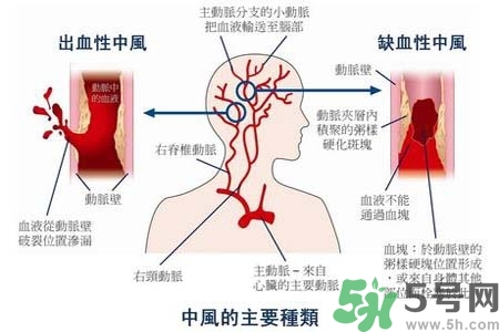 腦中風(fēng)是什么？腦中風(fēng)的癥狀？