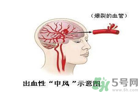 腦中風的護理措施？腦中風的飲食護理？