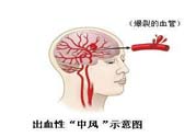 腦中風(fēng)的發(fā)病因素？腦中風(fēng)的并發(fā)癥有哪些 ？