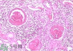 慢性腎炎能治好嗎？慢性腎炎能活多久？