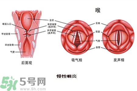 慢性咽炎是什么？慢性咽炎的癥狀有哪些？