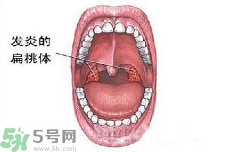 慢性咽炎是什么？慢性咽炎的癥狀有哪些？