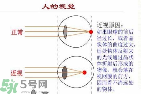 近視眼高發(fā)人群？如何預(yù)防近視眼？