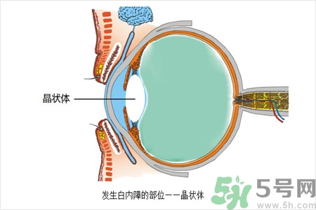 白內(nèi)障的護(hù)理措施是什么？白內(nèi)障的飲食護(hù)理有哪些？