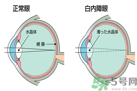 白內(nèi)障治療方法是什么？白內(nèi)障可以用什么藥物治療？