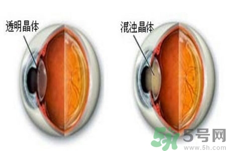 白內(nèi)障治療方法是什么？白內(nèi)障可以用什么藥物治療？