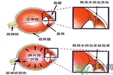 青光眼的發(fā)病因素是什么？青光眼的并發(fā)癥有哪些？