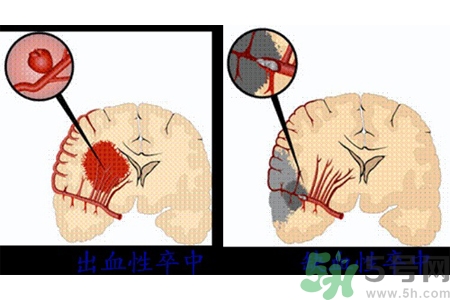 腦出血的發(fā)病因素是什么？腦出血的并發(fā)癥有哪些？