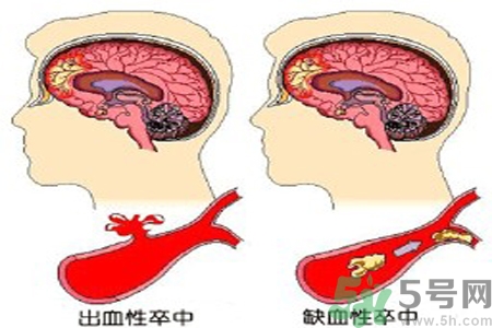 腦出血的治療方法是什么？腦出血可以用哪些藥物治療？
