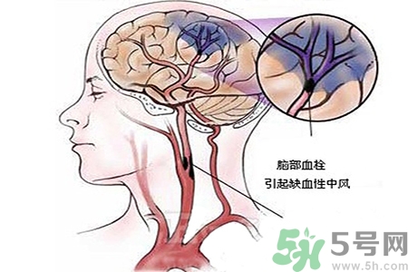 腦出血的治療方法是什么？腦出血可以用哪些藥物治療？