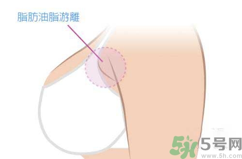 副乳是什么？副乳的危害