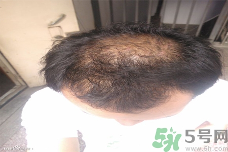 脫發(fā)的措施有什么？脫發(fā)的注意飲食有哪些？