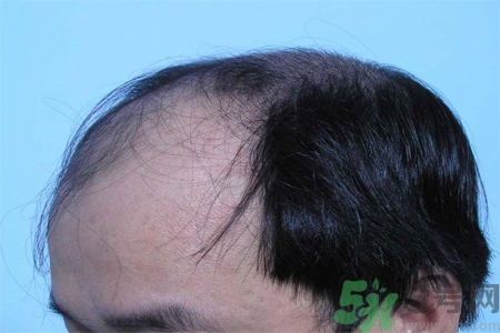 脫發(fā)的措施有什么？脫發(fā)的注意飲食有哪些？
