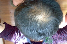 脫發(fā)的高發(fā)人群有哪些？如何預(yù)防脫發(fā)？