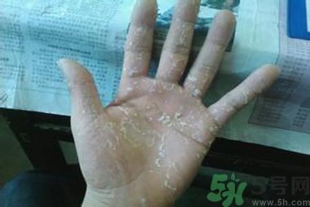 引起手足癬的主要原因？手足癬會(huì)引發(fā)什么疾??？
